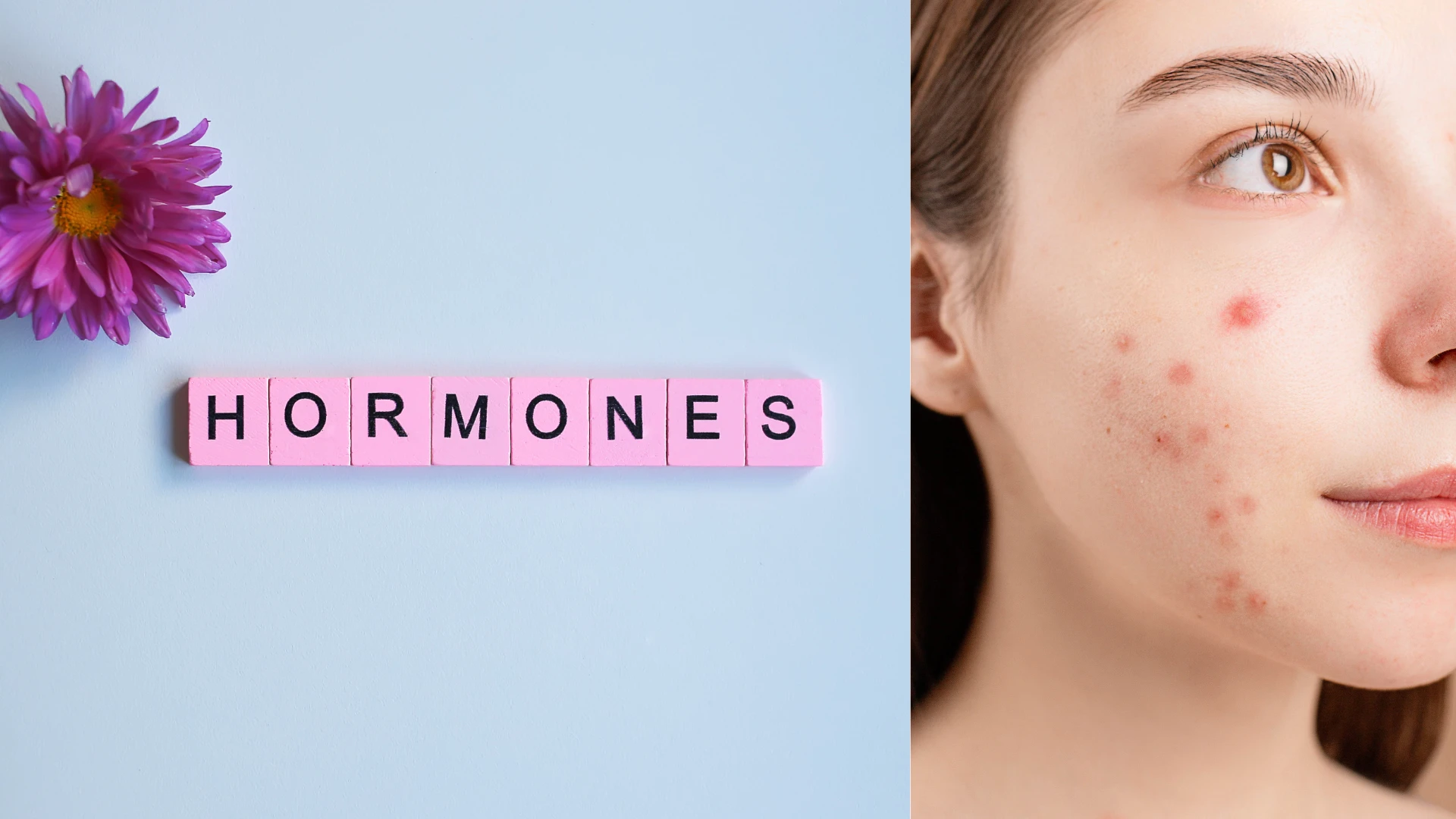Trądzik hormonalny: Przyczyny, objawy, leczenie